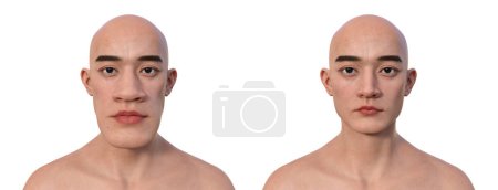 Foto de Acromegalia en un hombre, y el mismo hombre sano. Ilustración 3D que muestra un aumento en el tamaño de las manos y la cara debido a la sobreproducción de somatotropina causada por un tumor de la glándula pituitaria. - Imagen libre de derechos