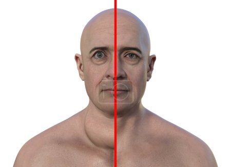 Photo for A man with enlarged thyroid gland and exophthalmos, and the same healthy person, 3D photorealistic illustration. Before and after treatment concept. - Royalty Free Image
