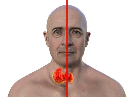 Foto de Un hombre con agrandamiento de la glándula tiroides y exoftalmos, y la misma persona sana, ilustración fotorrealista 3D. Concepto de tratamiento antes y después. - Imagen libre de derechos