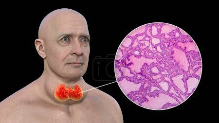 Foto de Una ilustración 3D de un hombre con agrandamiento de la glándula tiroides y exoftalmos, junto con una imagen micrográfica del tejido tiroideo afectado por el bocio tóxico. - Imagen libre de derechos