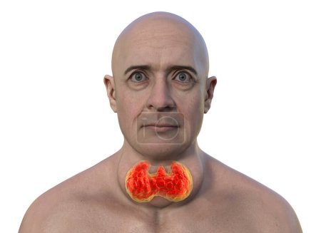 Foto de Un hombre con agrandamiento de la glándula tiroides y exoftalmos, ilustración fotorrealista 3D. - Imagen libre de derechos
