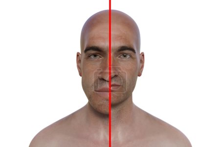 Akromegalie in einem Mann, und der gleiche gesunde Mann. 3D-Illustration, die eine Vergrößerung der Hände und des Gesichts durch eine Überproduktion von Somatotropin durch einen Tumor der Hypophyse zeigt.
