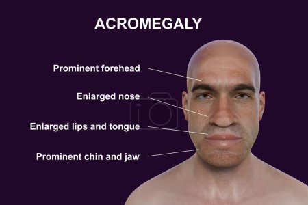 Téléchargez les photos : Acromégalie chez un homme, et le même homme en bonne santé. Illustration 3D montrant une augmentation de la taille des mains et du visage due à une surproduction de somatotrophine causée par une tumeur de l'hypophyse. - en image libre de droit