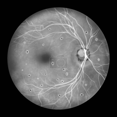 Photo for Retina in Presumed Ocular Histoplasmosis Syndrome as seen in fluorescein angiography, illustration shows punched-out atrophic and pigmented chorioretinal scars (histo spots) and peripapillary scarring - Royalty Free Image