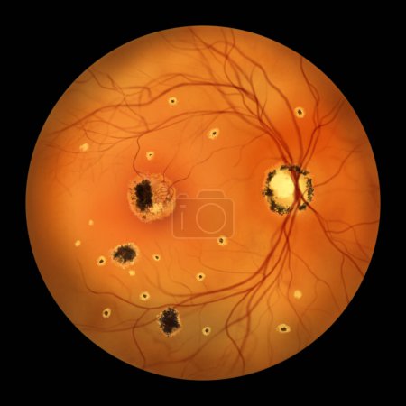 Photo for Retina in Presumed Ocular Histoplasmosis Syndrome as seen in ophthalmoscopy, illustration shows choroidal neovascularization, histo spots, fibrotic and pigment scars, and peripapillary scarring. - Royalty Free Image