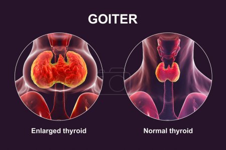 Foto de Una persona con agrandamiento de la glándula tiroides y la misma persona sana para comparar. Antes y después del tratamiento ilustración conceptual 3D. - Imagen libre de derechos