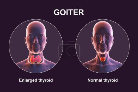 Foto de Una persona con agrandamiento de la glándula tiroides y la misma persona sana para comparar. Antes y después del tratamiento ilustración conceptual 3D. - Imagen libre de derechos
