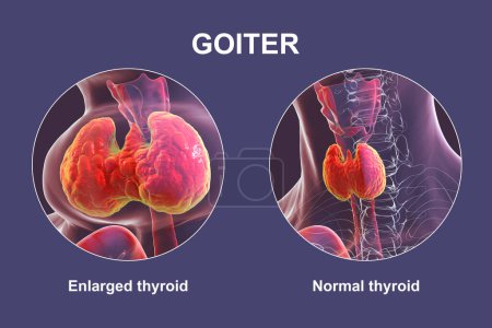 Téléchargez les photos : Une personne avec une glande thyroïde élargie et la même personne en bonne santé pour comparaison. Illustration 3D conceptuelle avant et après le traitement. - en image libre de droit
