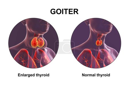 Photo for A person with enlarged thyroid gland and the same healthy person for comparison. Before and after treatment conceptual 3D illustration. - Royalty Free Image