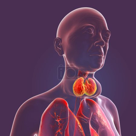 Téléchargez les photos : Une personne avec une glande thyroïde élargie, illustration 3D. - en image libre de droit