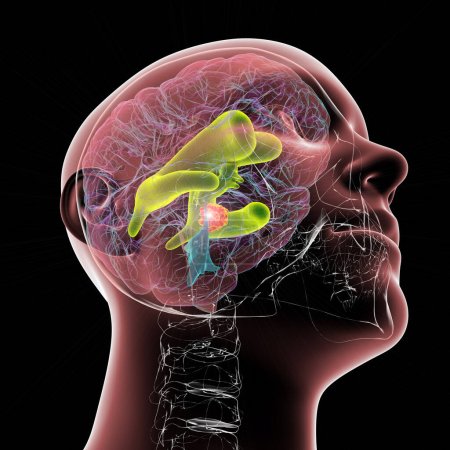 Photo for A 3D scientific illustration depicting enlarged lateral and third ventricles of the brain (hydrocephalus, indicated in green), caused by a brain tumor compressing the cerebral aqueduct (in orange). - Royalty Free Image