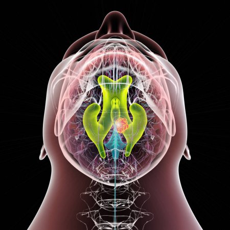Foto de Una ilustración científica en 3D que representa el agrandamiento de los ventrículos laterales y terceros del cerebro (hidrocefalia, indicada en verde), causada por un tumor cerebral que comprime el acueducto cerebral (en naranja). - Imagen libre de derechos