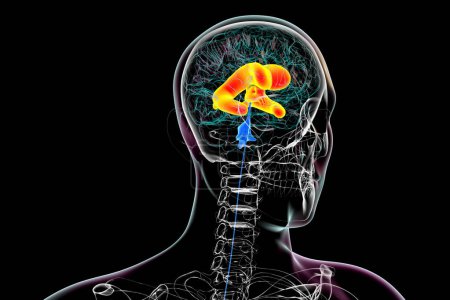 Foto de Ilustración científica en 3D que representa ventrículos laterales y terceros ampliados del cerebro (hidrocefalia). - Imagen libre de derechos