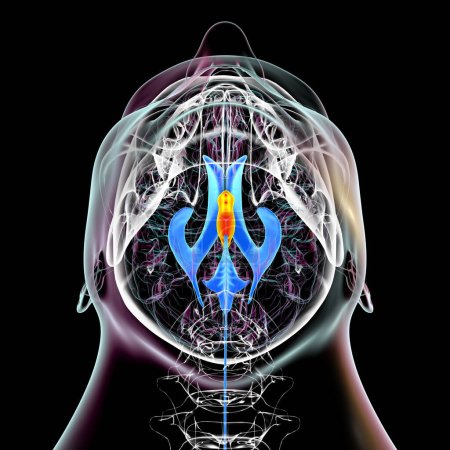 Foto de Una ilustración científica en 3D que representa el agrandamiento aislado del tercer ventrículo cerebral, vista inferior. - Imagen libre de derechos