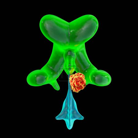 Photo for A 3D scientific illustration depicting enlarged lateral and third ventricles of the brain (hydrocephalus, indicated in green), caused by a brain tumor compressing the cerebral aqueduct (in red), front view. - Royalty Free Image