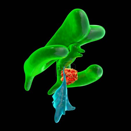Foto de Una ilustración científica en 3D que representa el agrandamiento de los ventrículos laterales y terceros del cerebro (hidrocefalia, indicada en verde), causada por un tumor cerebral que comprime el acueducto cerebral (en rojo). - Imagen libre de derechos