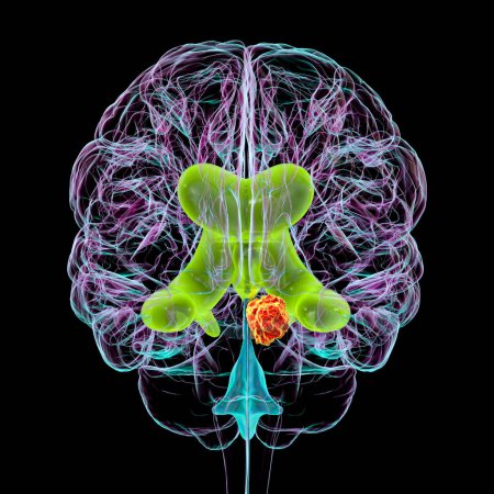 Photo for A 3D scientific illustration depicting enlarged lateral and third ventricles of the brain (hydrocephalus, indicated in green), caused by a brain tumor compressing the cerebral aqueduct (in red), front view. - Royalty Free Image