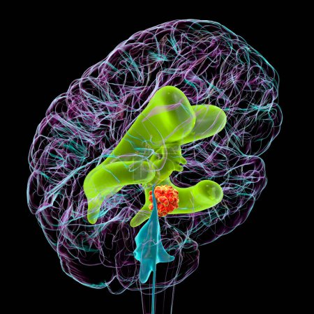 Photo for A 3D scientific illustration depicting enlarged lateral and third ventricles of the brain (hydrocephalus, indicated in green), caused by a brain tumor compressing the cerebral aqueduct (in red). - Royalty Free Image