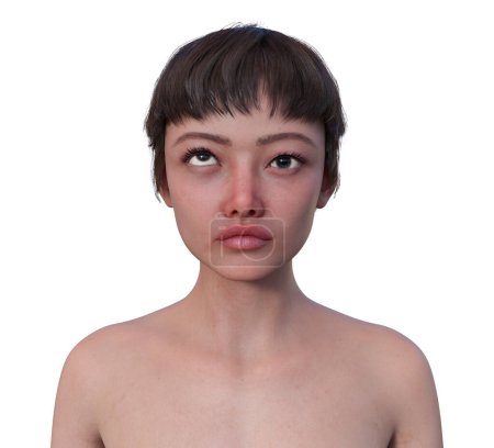 Foto de Una mujer con hipertropía, ilustración 3D con desalineación del ojo hacia arriba. - Imagen libre de derechos