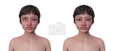 Foto de Una mujer con hipertropía y la misma persona sana, ilustración 3D con desalineación del ojo hacia arriba. - Imagen libre de derechos