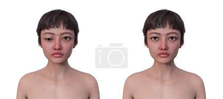Foto de Una mujer con hipotropía y la misma mujer sana, ilustración 3D mostrando desalineación de los ojos hacia abajo. - Imagen libre de derechos