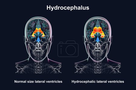 Photo for A 3D scientific illustration depicting enlarged lateral ventricles of the human brain (hydrocephalus, right side, indicated in orange), and normal lateral ventricles (left side), front view. - Royalty Free Image