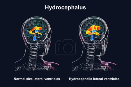 Foto de Una ilustración científica en 3D que representa ventrículos laterales agrandados del cerebro humano (hidrocefalia, lado derecho, indicada en naranja), y ventrículos laterales normales (lado izquierdo, en naranja). - Imagen libre de derechos