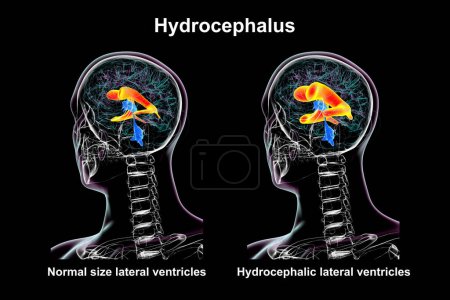 Téléchargez les photos : Illustration scientifique 3D représentant des ventricules latéraux élargis du cerveau humain (hydrocéphalie, côté droit, indiquée en orange) et des ventricules latéraux normaux (côté gauche, en orange)). - en image libre de droit