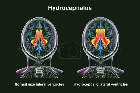 Photo for A 3D scientific illustration depicting enlarged lateral ventricles of the human brain (hydrocephalus, right side, indicated in orange), and normal lateral ventricles (left side), top view. - Royalty Free Image