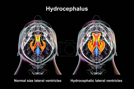 Téléchargez les photos : Illustration scientifique 3D représentant des ventricules latéraux élargis du cerveau humain (hydrocéphalie, côté droit, indiquée en orange) et des ventricules latéraux normaux (côté gauche), vue du bas. - en image libre de droit