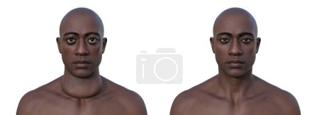 Téléchargez les photos : Un homme avec une glande thyroïde élargie et l'exophtalmie, et la même personne en bonne santé, illustration photoréaliste 3D. Concept de traitement avant et après. - en image libre de droit
