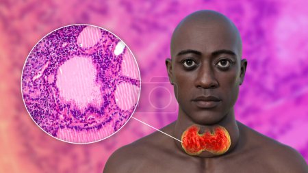 Photo for A 3D illustration of a man with enlarged thyroid gland, alongside with a micrograph image of thyroid tissue affected by toxic goiter. - Royalty Free Image