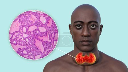 Photo for A 3D illustration of a man with enlarged thyroid gland, alongside with a micrograph image of thyroid tissue affected by toxic goiter. - Royalty Free Image
