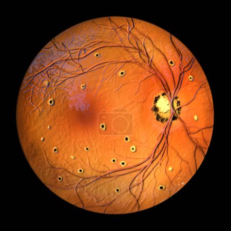 Foto de Retina en el Síndrome de Histoplasmosis Ocular Presunta como se observa en la oftalmoscopia, la ilustración 3D muestra cicatrices coriorretinianas atróficas y pigmentadas perforadas (manchas histo) y cicatrices peripapilares. - Imagen libre de derechos