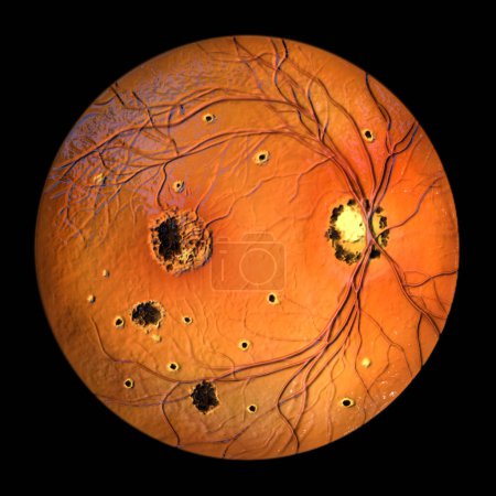 Foto de Retina en el Síndrome de Histoplasmosis Ocular Presunta como se ve en la oftalmoscopia, la ilustración 3D muestra neovascularización coroidea, manchas histo, cicatrices fibrosas y pigmentarias, y cicatrices peripapilares. - Imagen libre de derechos