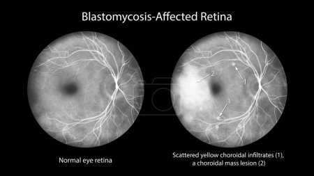 Photo for Retina in blastomycosis (infection caused by fungi Blastomyces dermatitidis) as seen in fluorescein angiography. Illustration shows scattered choroidal infiltrates and a mass lesion with dye leakage. - Royalty Free Image