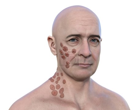 Foto de Ilustración 3D que representa a un hombre con múltiples lesiones en la cara y el cuello, mostrando blastomicosis cutánea, causada por el hongo Blastomyces dermatitidis. - Imagen libre de derechos