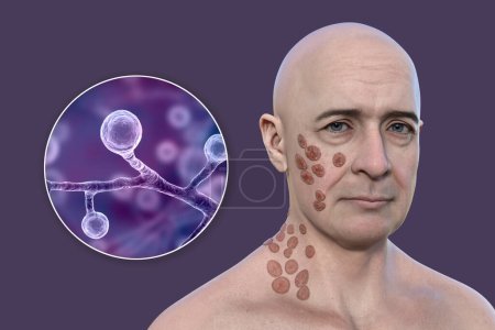 Foto de Ilustración 3D que representa a un hombre con múltiples lesiones en la cara y el cuello, mostrando blastomicosis cutánea, y vista de cerca de los hongos Blastomyces dermatitidis. - Imagen libre de derechos