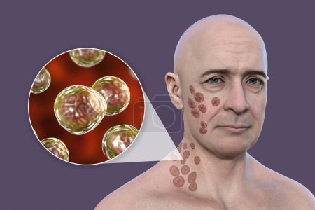 Téléchargez les photos : Illustration 3D représentant un homme présentant de multiples lésions au visage et au cou, une blastomycose cutanée et une vue rapprochée des champignons Blastomyces dermatitidis. - en image libre de droit