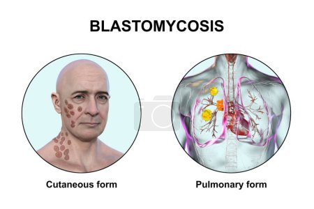 Téléchargez les photos : Formes cliniques de blastomycose. Blastomycose cutanée et pulmonaire, illustration 3D. - en image libre de droit