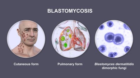 Téléchargez les photos : Formes cliniques de blastomycose. Blastomycose cutanée et pulmonaire et vue rapprochée des champignons Blastomyces dermatitidis, illustration 3D. - en image libre de droit