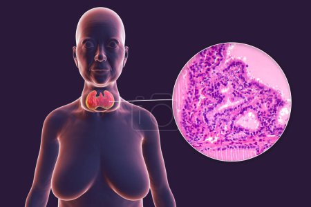 Téléchargez les photos : Illustration 3D d'une patiente présentant une hypertrophie de la glande thyroïde et une exophtalmie, accompagnée d'une image micrographique du tissu thyroïdien affecté par un goitre toxique. - en image libre de droit