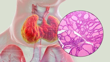 Téléchargez les photos : Illustration 3D d'une personne ayant une glande thyroïde élargie, accompagnée d'une image micrographique du tissu thyroïdien affecté par un goitre toxique. - en image libre de droit