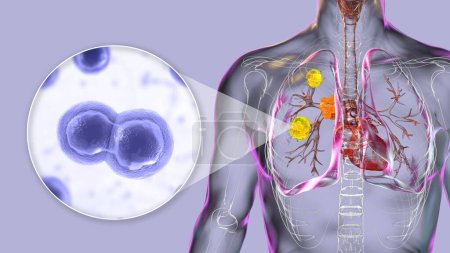 Foto de Blastomicosis pulmonar con lesiones pulmonares y ganglios linfáticos bronquiales agrandados, y vista de cerca del hongo Blastomyces dermatitidis, ilustración 3D. - Imagen libre de derechos