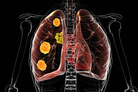 Foto de Blastomicosis pulmonar con lesiones pulmonares y ganglios linfáticos bronquiales agrandados, causada por el hongo Blastomyces dermatitidis, ilustración 3D. - Imagen libre de derechos