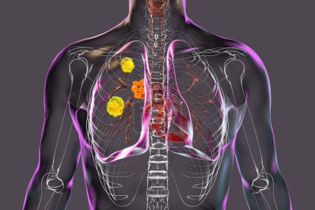 Lungenblastomykose mit Lungenläsionen und vergrößerten Bronchiallymphknoten, verursacht durch den Pilz Blastomyces dermatitidis, 3D-Illustration.