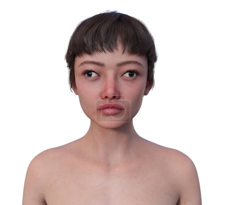 Foto de Una mujer con exotropía, ilustración 3D que demuestra una desalineación ocular externa. - Imagen libre de derechos