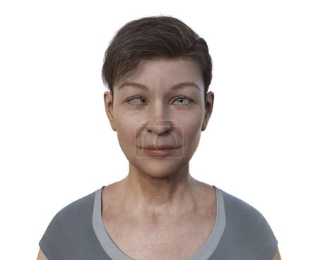 Foto de Una mujer con esotropía, ilustración 3D mostrando desalineación ocular interna. - Imagen libre de derechos