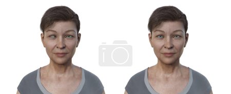 Foto de Una mujer con esotropía y la misma persona sana. Ilustración 3D que muestra la desalineación del ojo interno. - Imagen libre de derechos