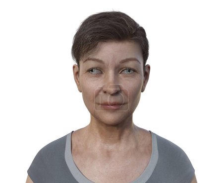 Téléchargez les photos : Une femme avec exotropie, illustration 3D démontrant un décalage oculaire vers l'extérieur. - en image libre de droit